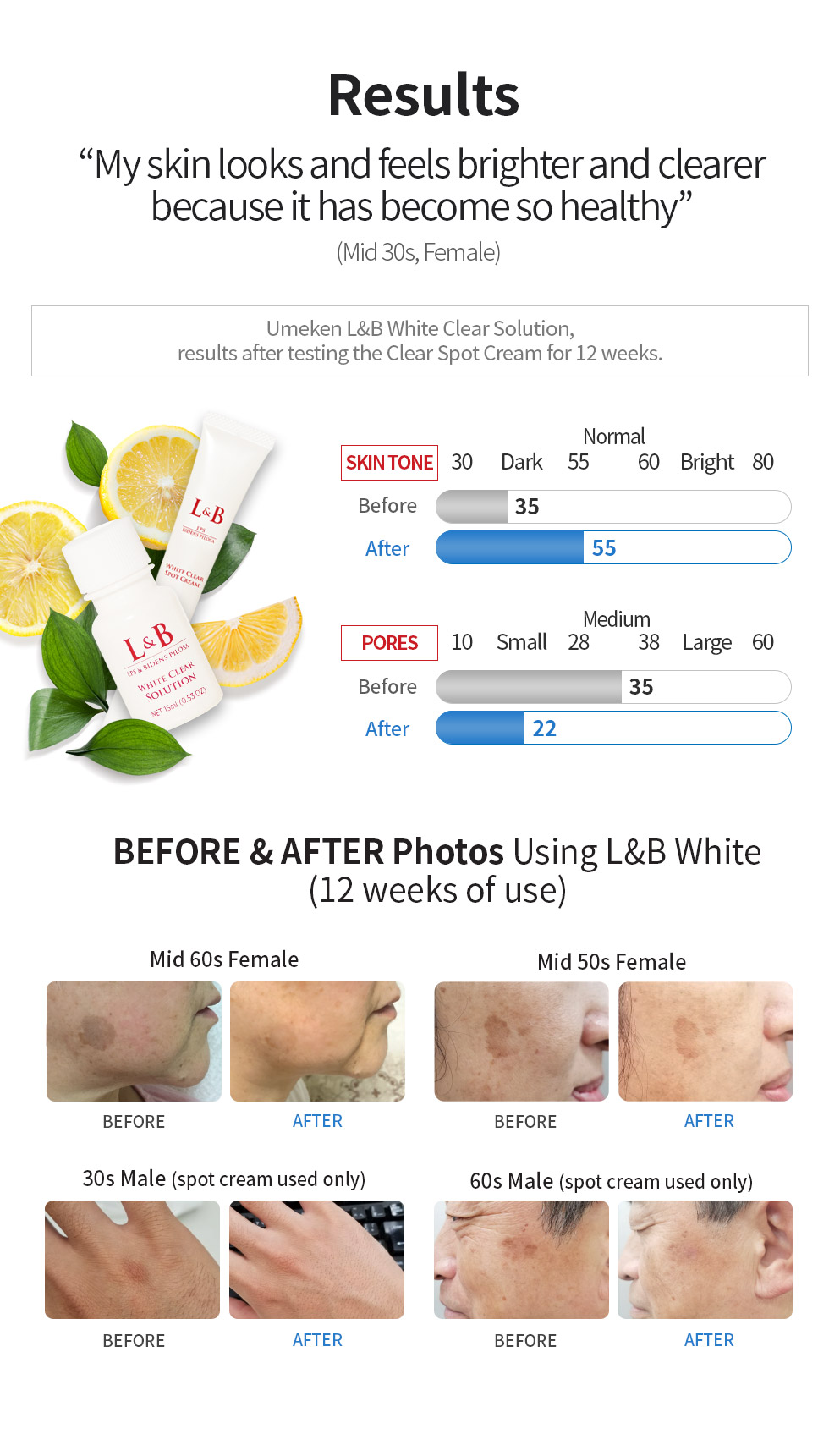 LNB white spot cream4